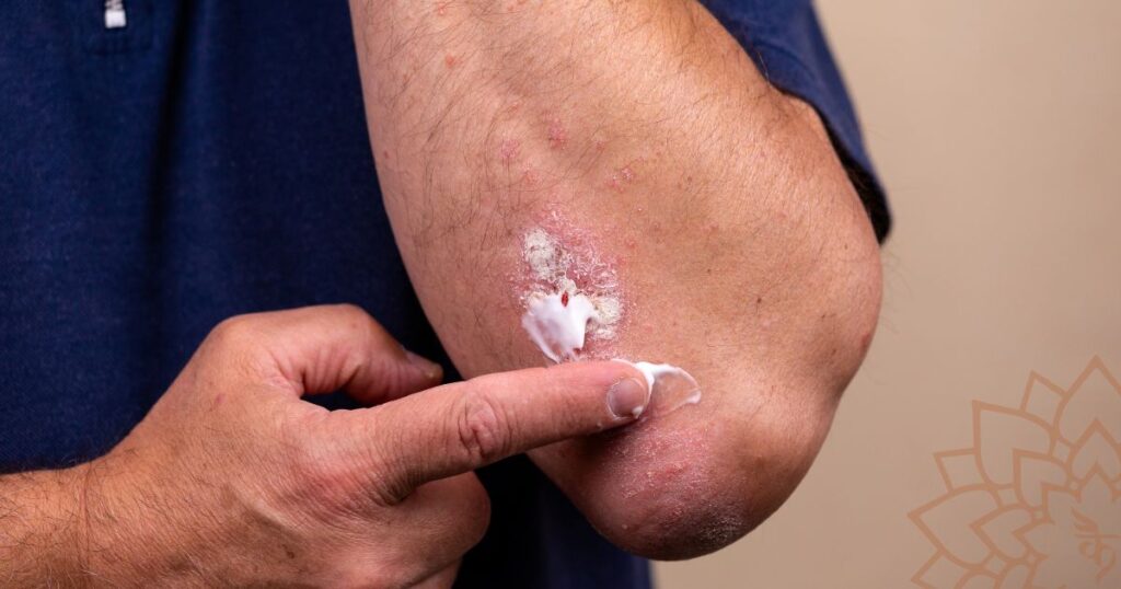 Ayurvedic Skin Disease Care for Psoriasis, Eczema and Common Skin Problems